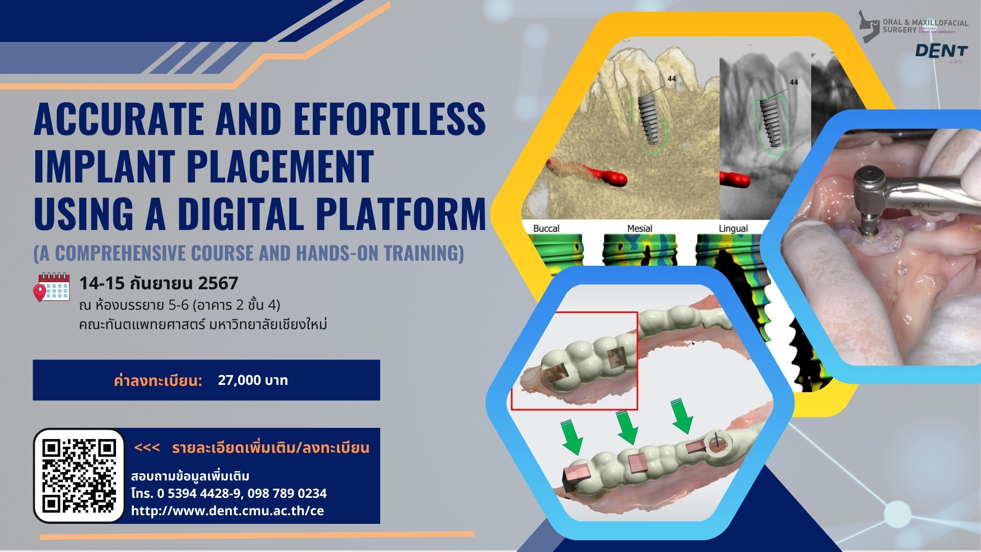 โครงการประชุมวิชาการ เรื่อง “Accurate and Effortless Implant Placement Using A Digital Platform” (A Comprehensive Course and Hands-On Training)