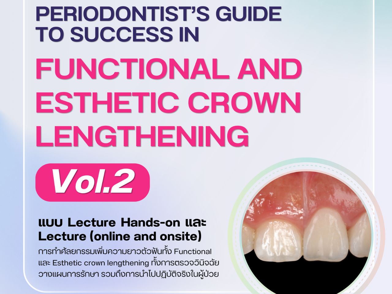 โครงการประชุมวิชาการ เรื่อง “Periodontist’s guide to success in functional and esthetic crown lengthening Vol.2”